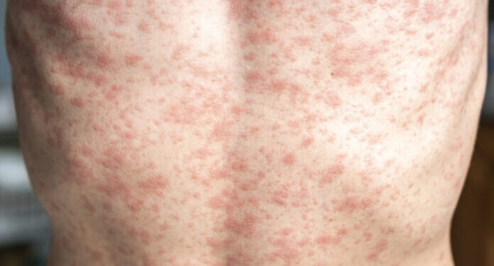 Alarma por Sarampión en Chile: ¿Qué hacer y cómo prevenir contagios?